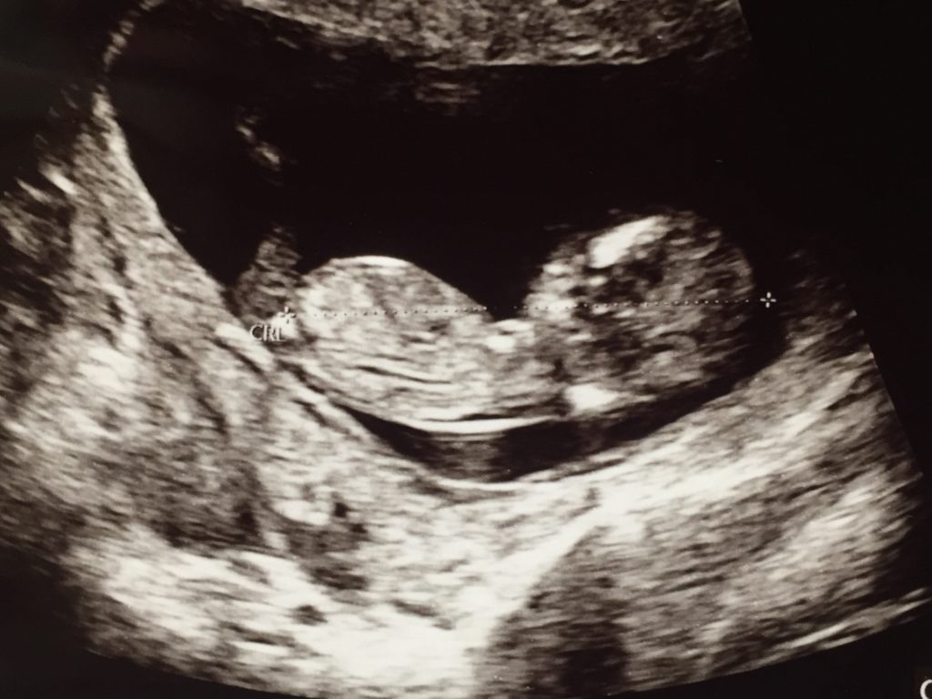 妊娠7週目のエコー・赤ちゃんが小さい？大きさには個人差がある ファインドクリップ